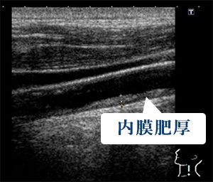 画像：頸動脈超音波検査レントゲン図