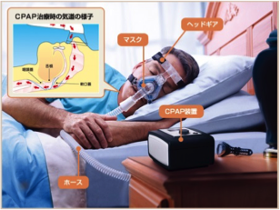 画像：CPAP装置による治療
